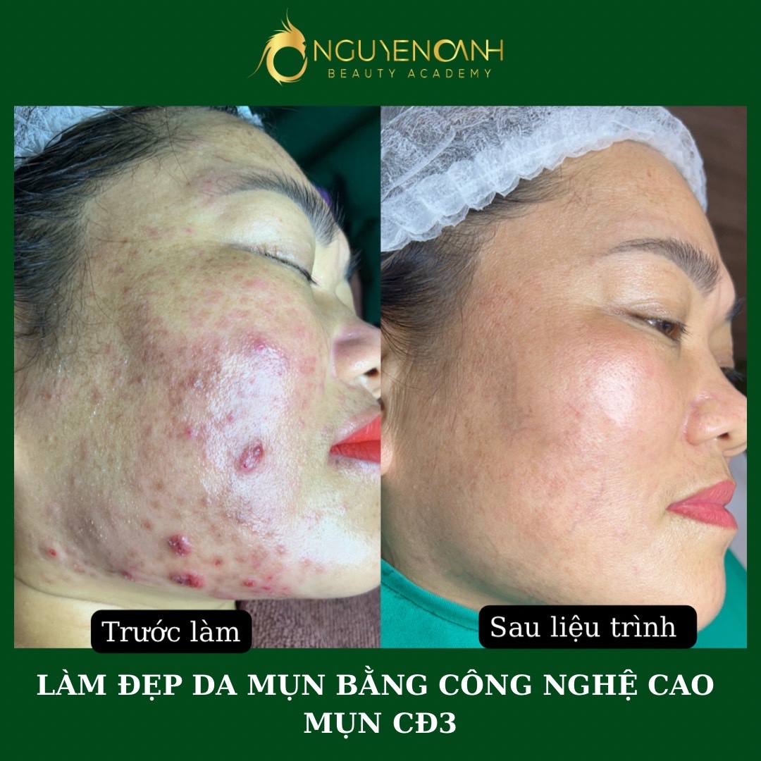 Dịch vụ trị mụn, trị sẹo bằng công nghệ cao