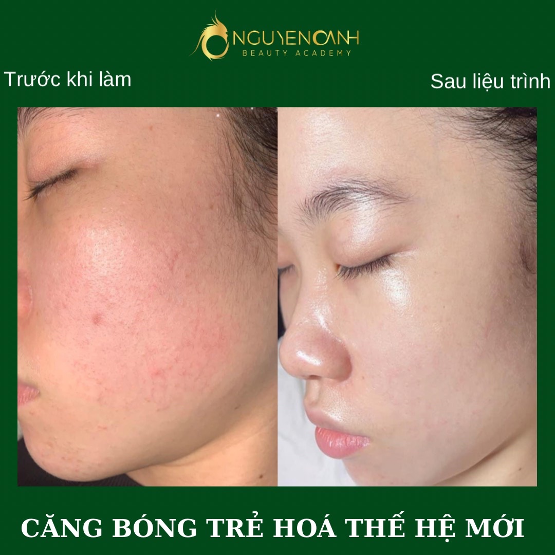 Thẩm mỹ Nguyễn Oanh là địa chỉ spa chăm sóc da Tuyên Quang uy tín